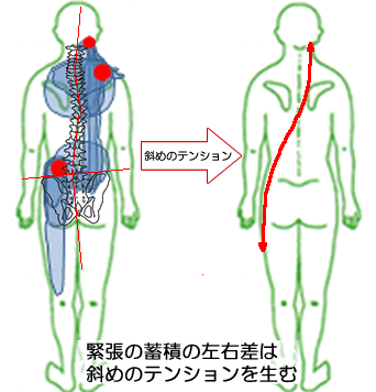 斜めのテンション左右差が生じているイメージ