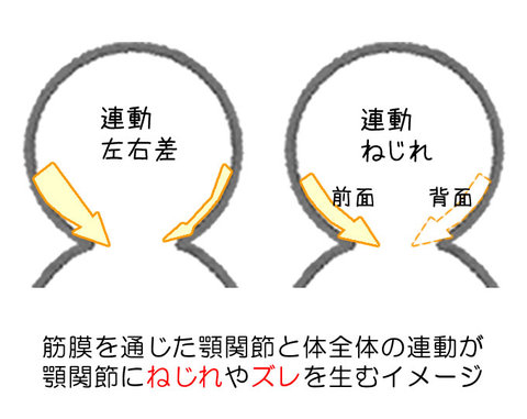 筋膜を通じた顎関節と体全体の連動が顎関節にねじれやズレを生むイメージ