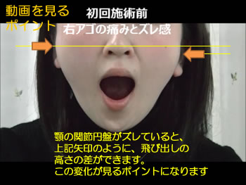 初回施術前 関節円板のズレ
