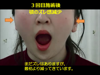 3回目施術後 ズレが少なくなってきた