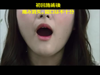 M様 開口 初回施術後