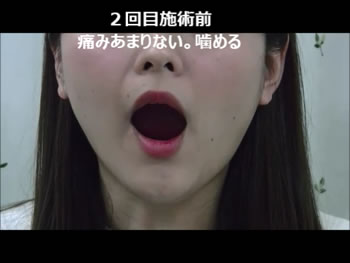 M様 開口 2回目施術前