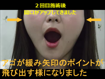 M様 開口 2回目施術後 顎関節が緩みました