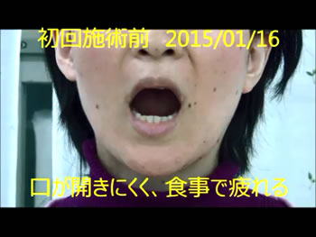 Y様 開口 初回施術前