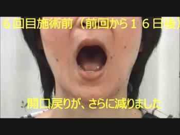 Y様 開口 6回目施術前 開口戻りがさらに減った