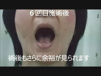 Y様 開口 6回目施術後 術後さらに開口に余裕