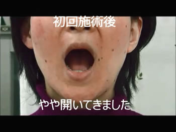 Y様 開口 初回施術後