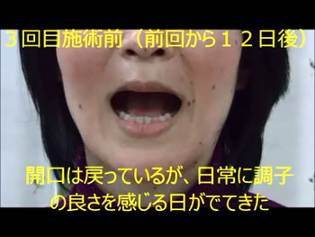 Y様 開口 3回目施術前