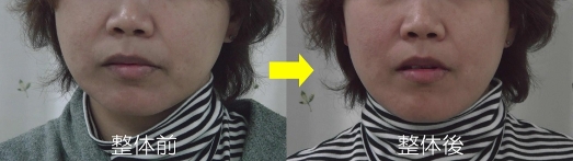 A様:蓄積の左右差で右側に顔がブレている→蓄積が減ると自然と正面に定まる